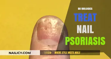 Biologics for Nail Psoriasis: Effective Treatment or Myth?