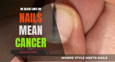 Black Lines on Nails: Unraveling the Cancer Myth