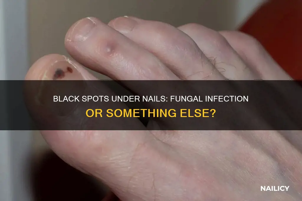 do black spots under nails mean fungus