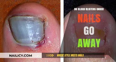 Blood Blisters Under Nails: Healing Time and Treatment Options