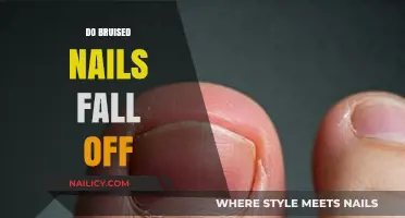 Do Bruised Nails Fall Off? Understanding Nail Trauma and Recovery