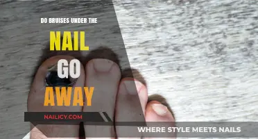 Do Bruises Under the Nail Heal? Understanding Subungual Hematomas