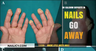 Calcium Deposits in Nails: Causes, Treatments, and Removal Options