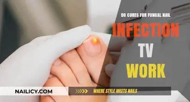 Do TV-Advertised Fungal Nail Infection Cures Really Deliver Results?