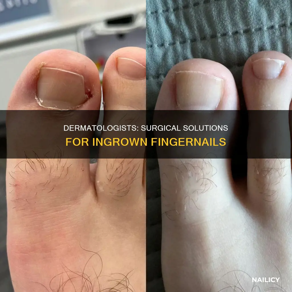 do dermatologist surgically remove ingrown finger nails