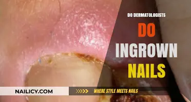 Do Dermatologists Treat Ingrown Nails? Expert Insights and Solutions