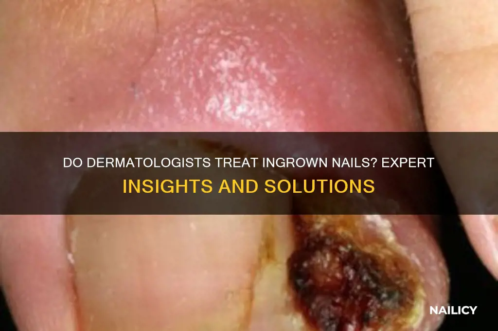 do dermatologists do ingrown nails