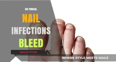 Do Fungal Nail Infections Bleed? Understanding Symptoms and Treatment Options