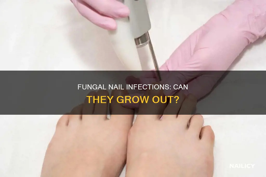do fungal nail infections grow out