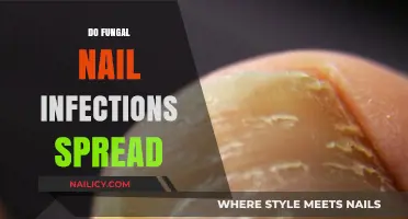 Can Fungal Nail Infections Spread? Understanding Transmission and Prevention