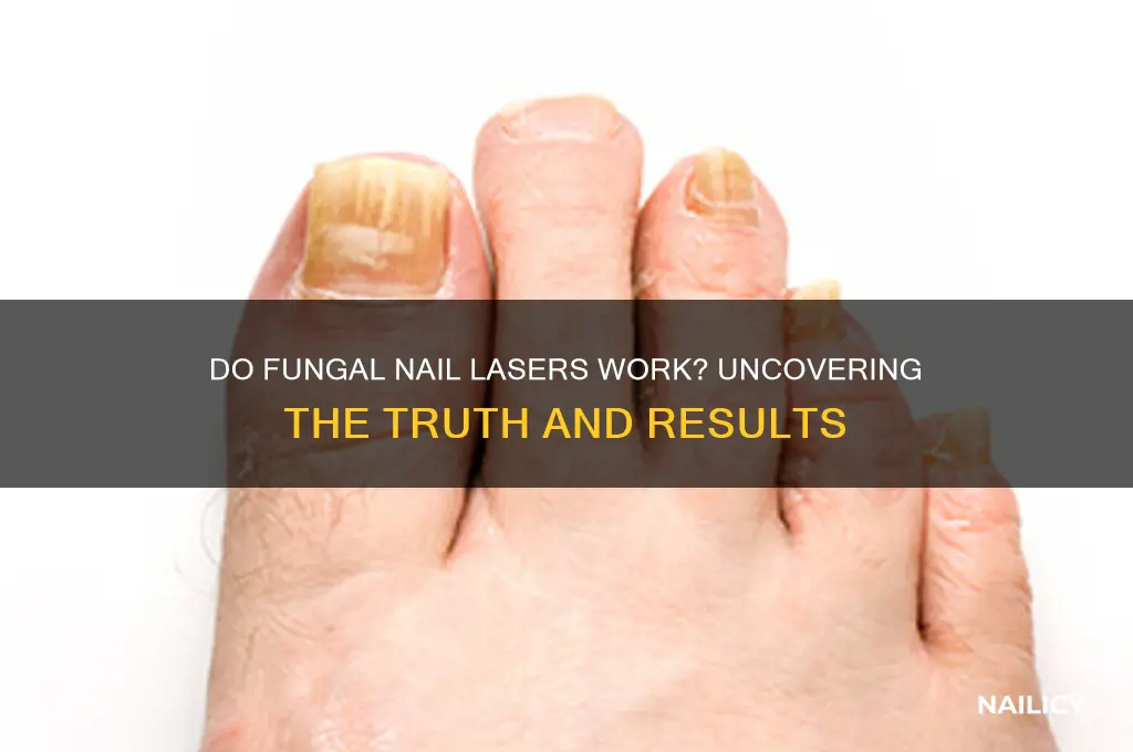 do fungal nail lasers work