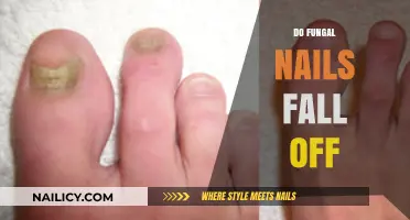 Do Fungal Nails Fall Off? Understanding Treatment and Recovery Process