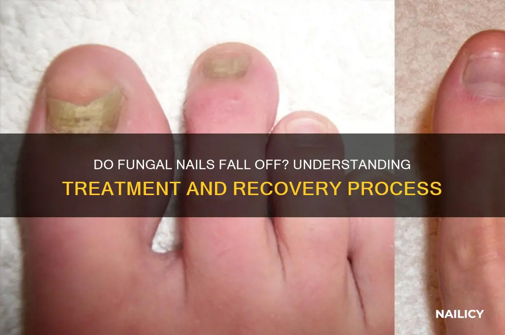 do fungal nails fall off