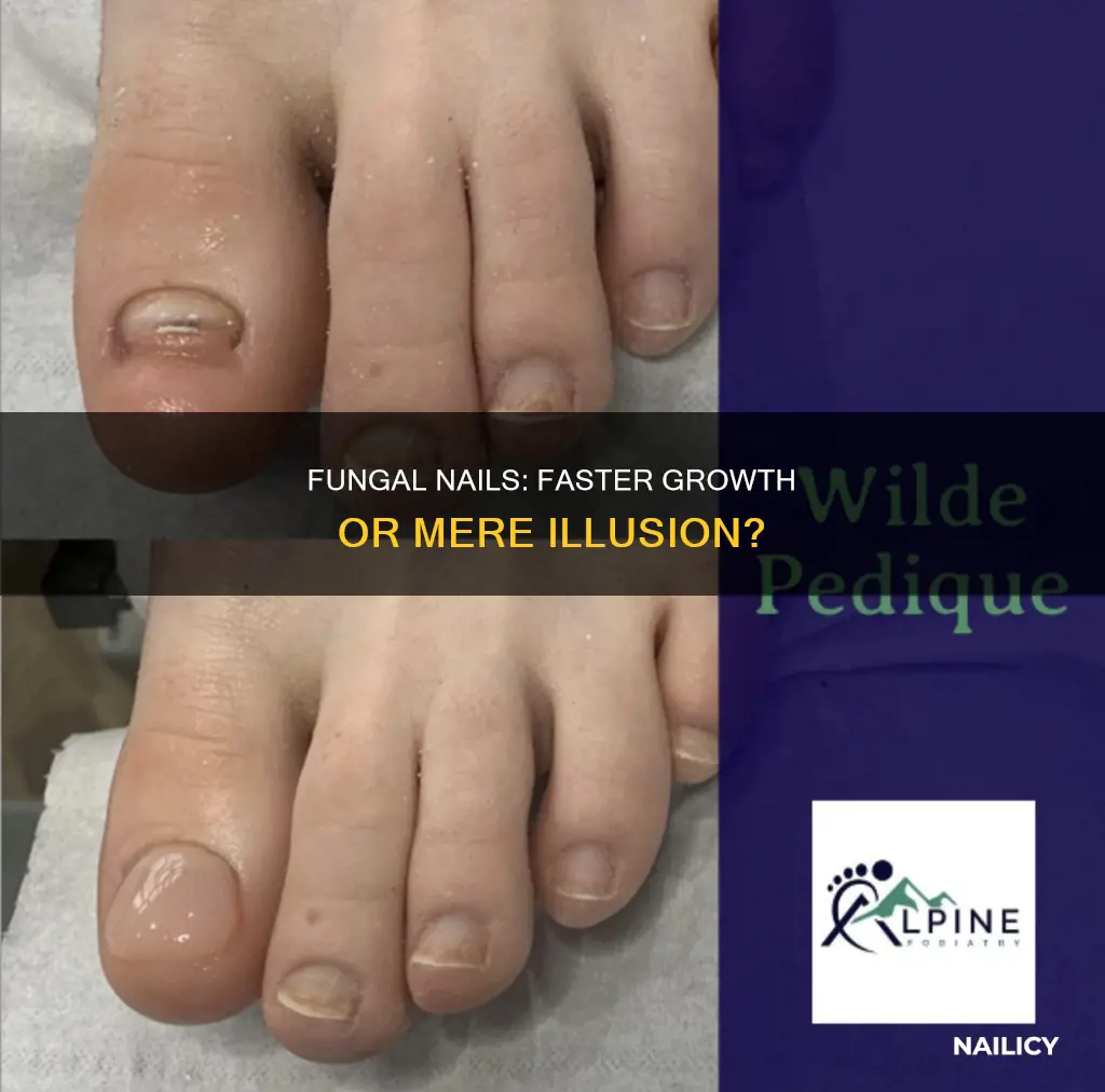 do fungal nails grow faster