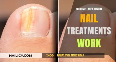 Home Laser Fungal Nail Treatments: Effective Solution or Just a Fad?