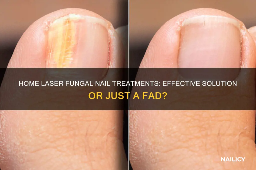 do home laser fungal nail treatments work