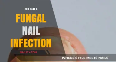 Do I Have a Fungal Nail Infection? Symptoms and Solutions