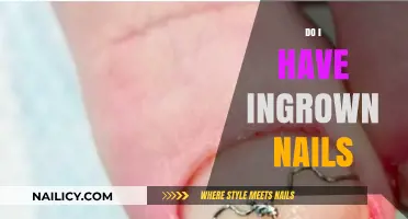 Ingrown Nails: Symptoms, Causes, and When to Seek Treatment