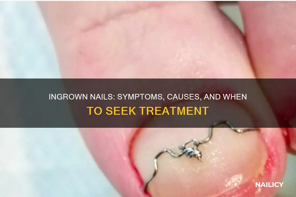 do i have ingrown nails