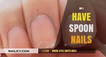 Spoon Nails: Understanding Causes, Symptoms, and Treatment Options