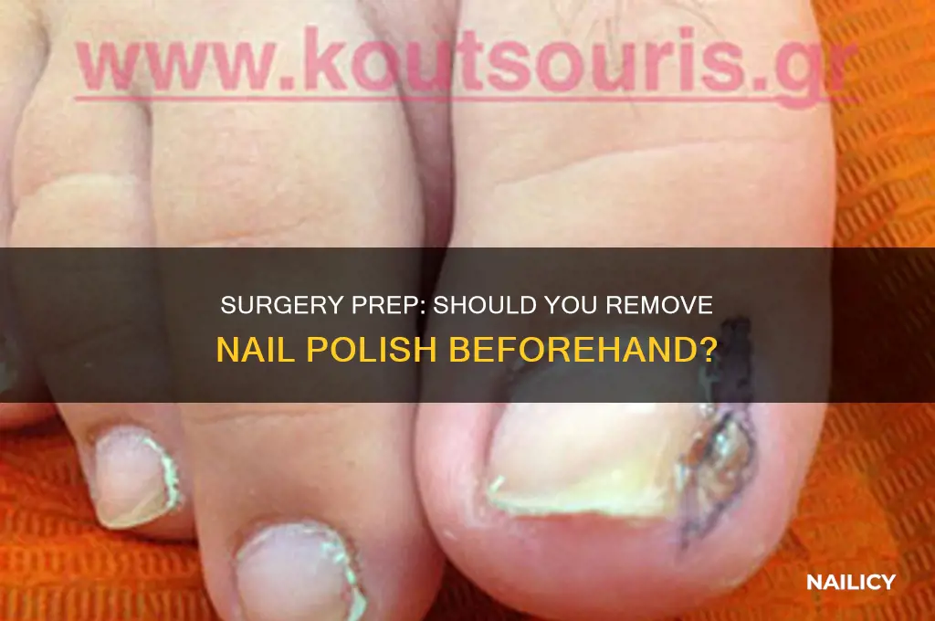 do i have to take nail polish off before surgery