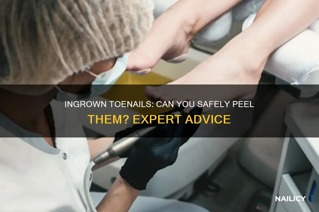 do in grown nails peel