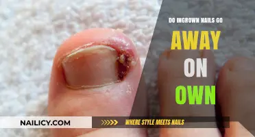 Can Ingrown Nails Heal Without Treatment? What You Need to Know
