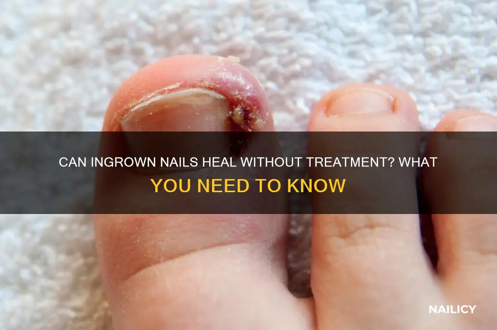 do ingrown nails go away on own