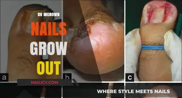 Ingrown Nails: Can They Grow Out?