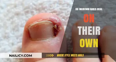 Can Ingrown Nails Heal Naturally? Understanding Self-Healing Potential