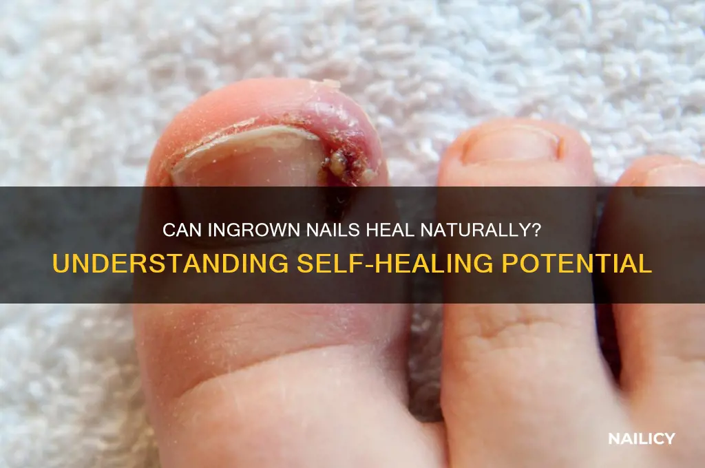 do ingrown nails heal on their own