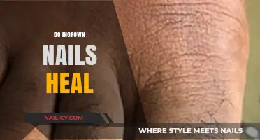 Do Ingrown Nails Heal? Understanding Treatment and Recovery Process