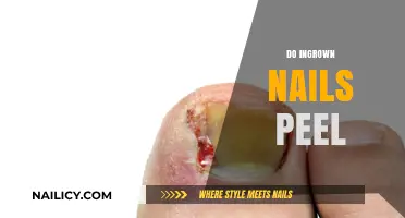 Do Ingrown Nails Peel? Understanding Symptoms, Causes, and Treatments
