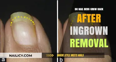 Can Ingrown Nail Bed Removal Lead to Regrowth?