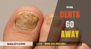 Do Nail Dents Disappear? Causes, Treatments, and Prevention Tips