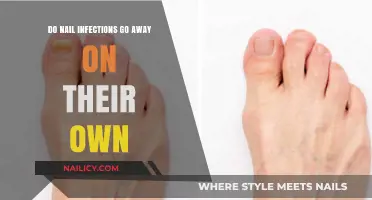 Can Nail Infections Heal Without Treatment? What You Need to Know
