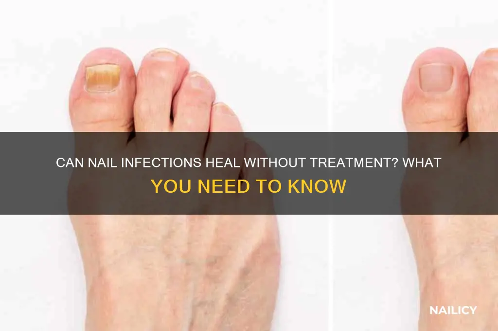 do nail infections go away on their own