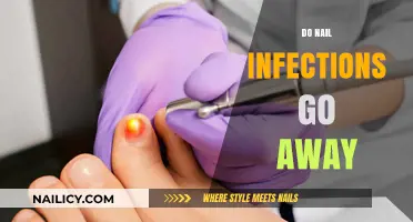 Do Nail Infections Go Away? Understanding Treatment and Recovery