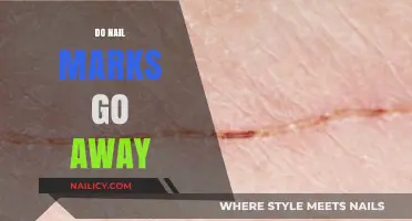 Do Nail Marks Fade? Healing and Removing Scratch Scars Naturally