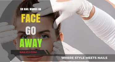 Nail Marks on Face: Will They Fade or Stay?