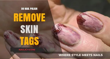 Nail Polish: Skin Tag Removal Solution?