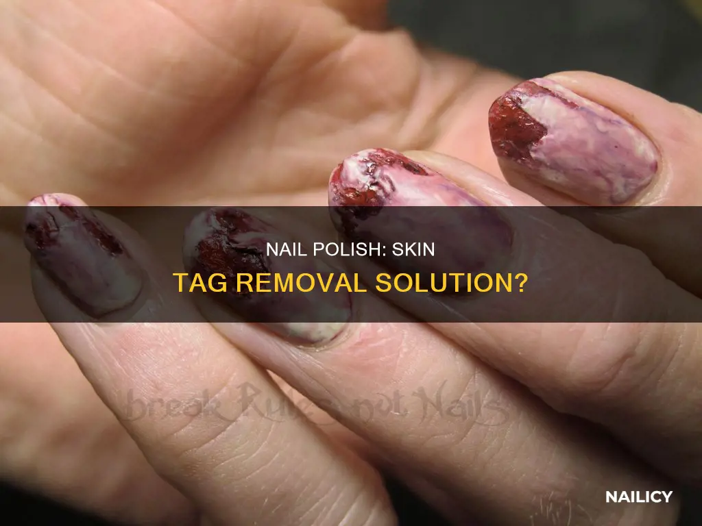 do nail polish remove skin tags