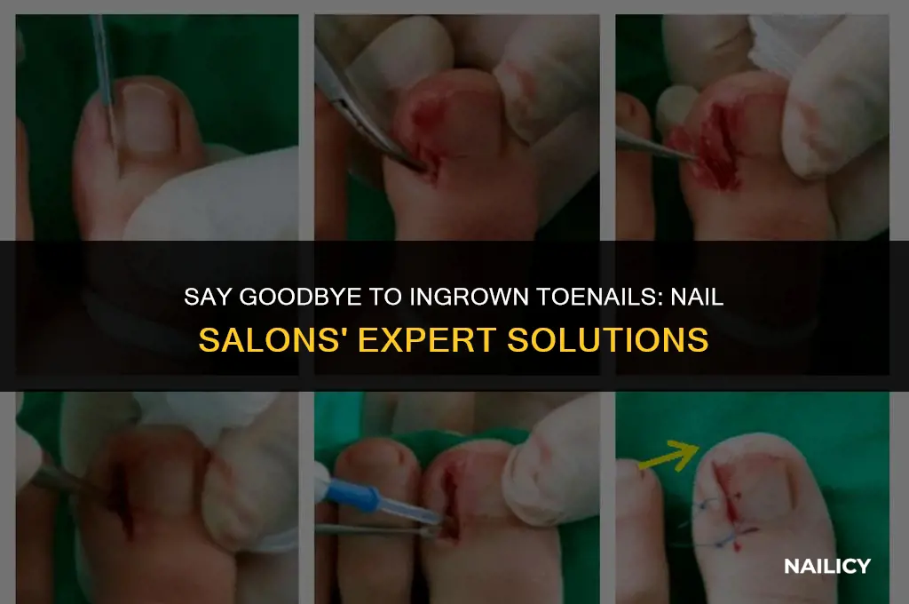 do nail salons get rid of ingrown toenails