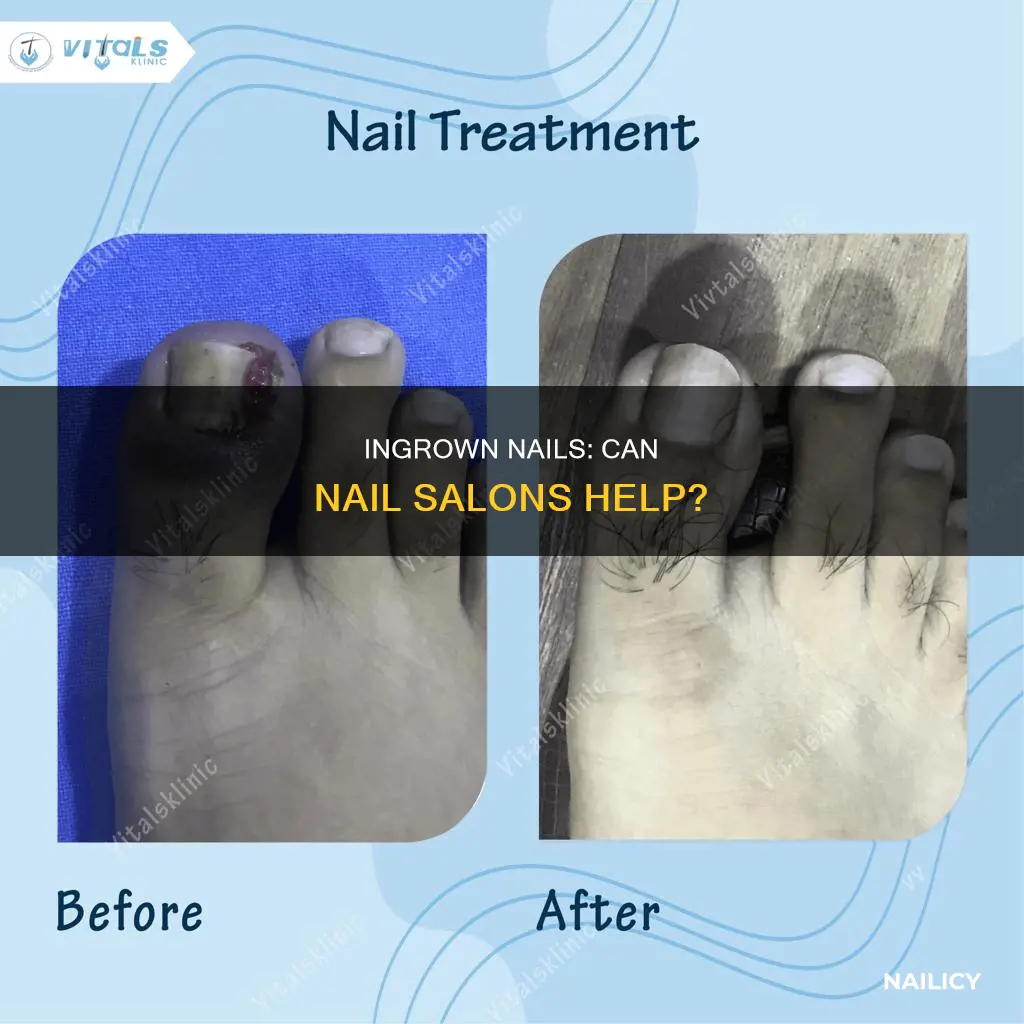 do nail salons remove ingrown nails