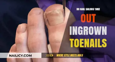 Can Nail Salons Safely Remove Ingrown Toenails? What You Need to Know