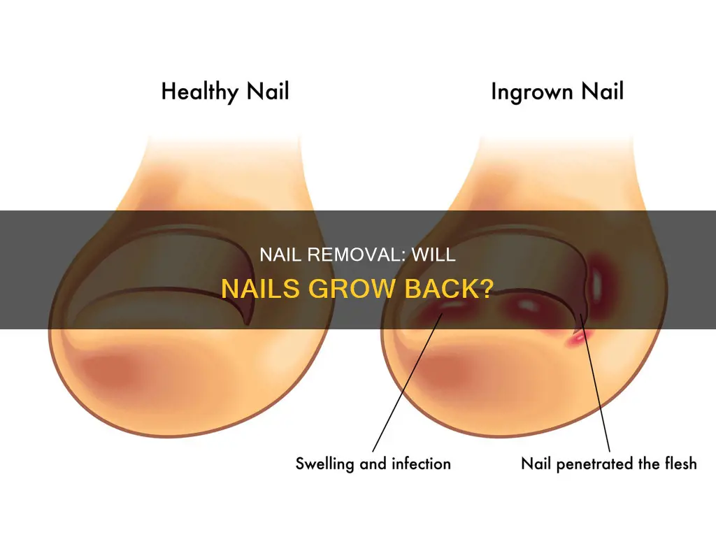 do nails grow back after removal