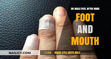 Hand, Foot, and Mouth Disease: Why Nails May Peel Afterward