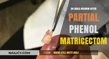 Nail Regrowth After Partial Phenol Matricectomy: What to Expect