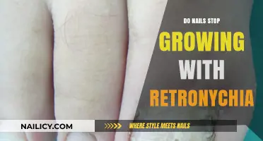 Retronychia: What It Is and How It Affects Nail Growth