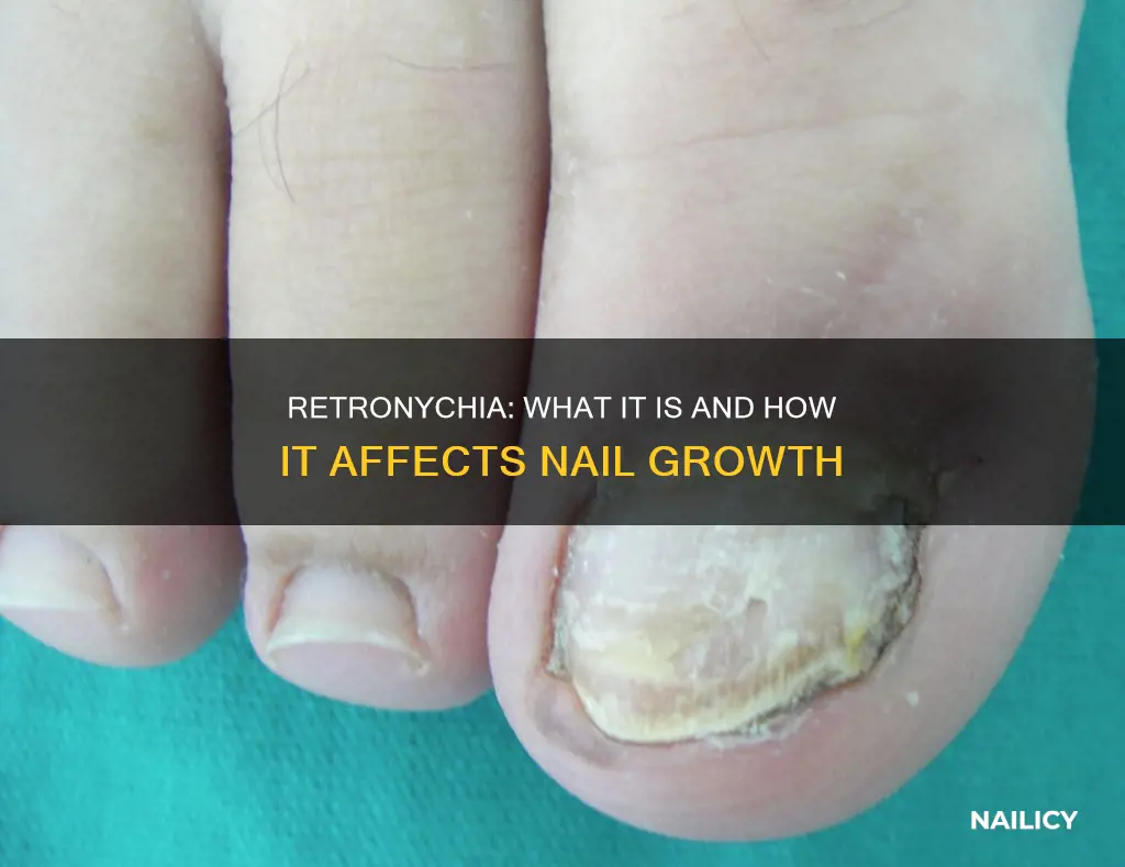 do nails stop growing with retronychia